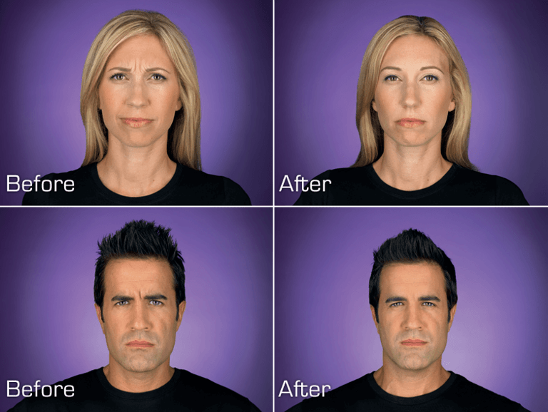 BOTOX Cosmetic before and after